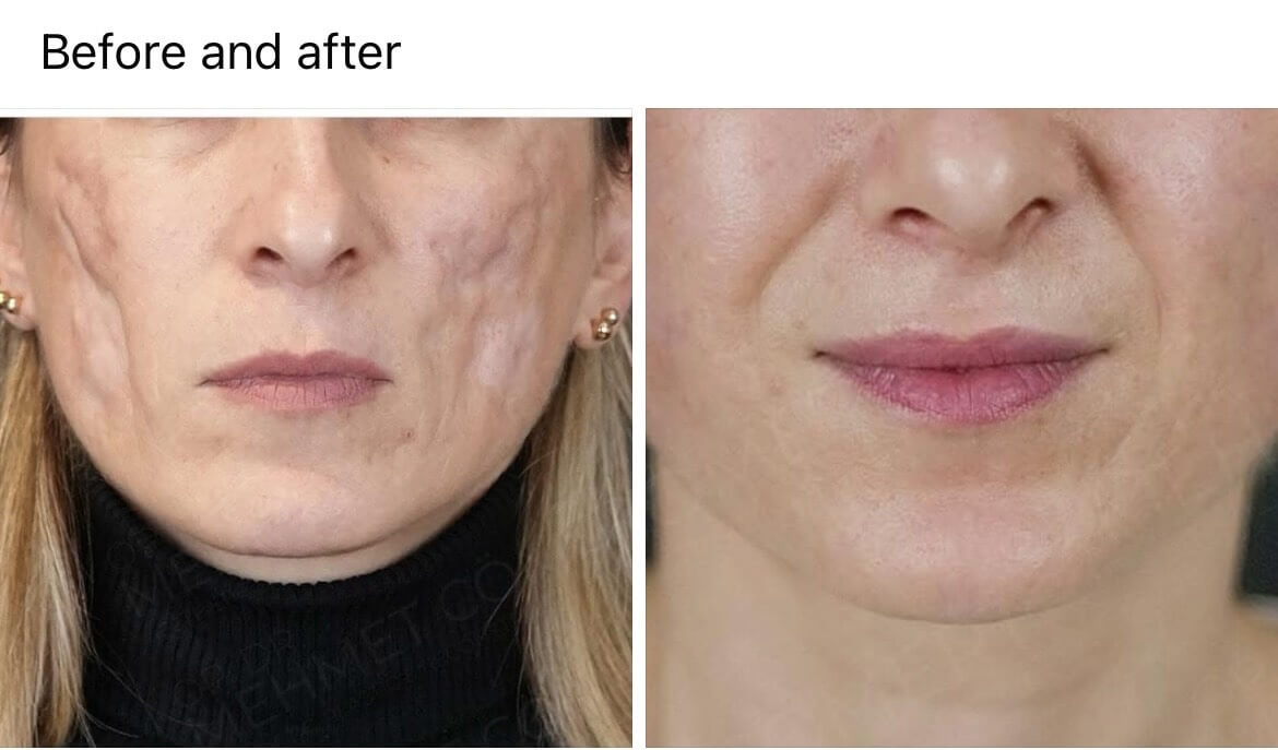 Remove Scars by Fillers